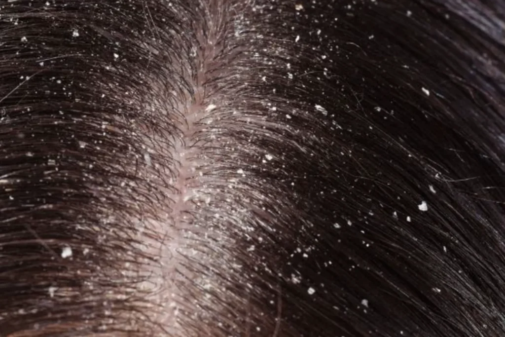 Hair tonic untuk rambut ketombe