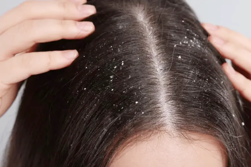 Rekomendasi shampo anti ketombe