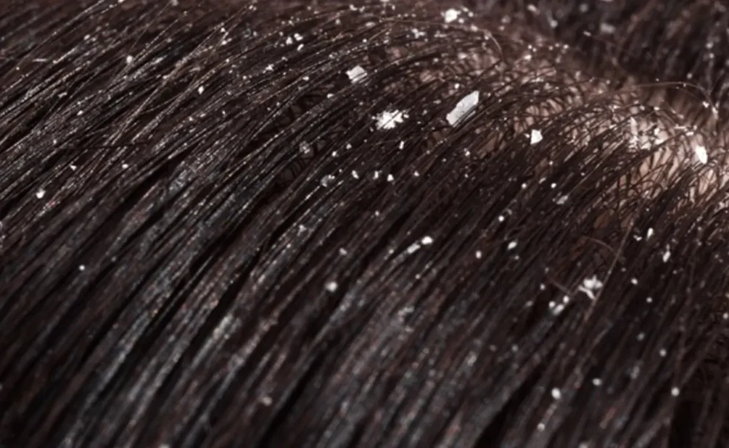Hair Tonic Reactive untuk Mengatasi Ketombe